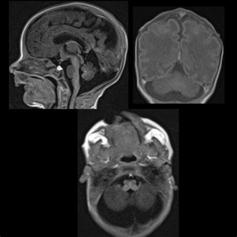 Mega Cisterna Magna | Pediatric Radiology Reference Article | Pediatric ...