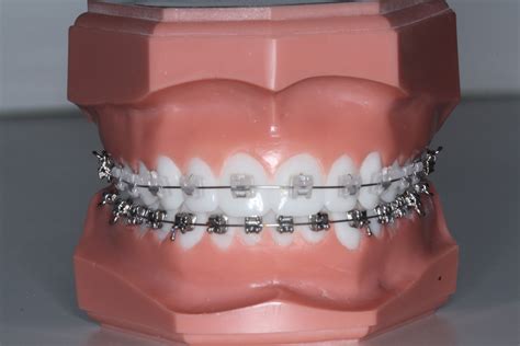 Clear Braces - Rhoads Orthodontic Specialist