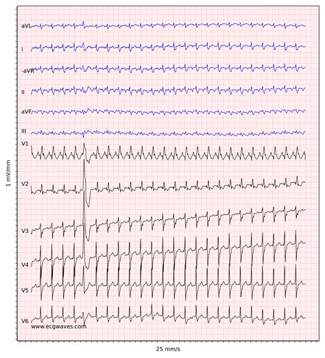 Atrial Flutter Ekg Atrial Flutter Ekg Abnormal Rhythm Abnormal | The ...