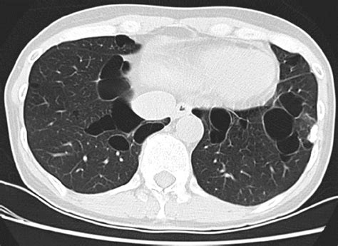 Diffuse Cystic Lung Diseases | Respiratory Care