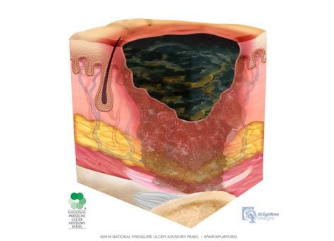 Unstageable-Presure-Injury-Dark-Eschar - Dr. Novikov Wound Care Program