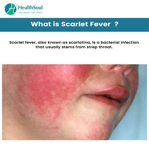 Scarlet Fever: Symptoms and Treatment – Healthsoul