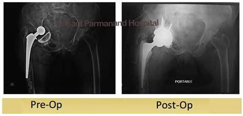 Partial Hip Replacement | Sant Parmanand Hospital