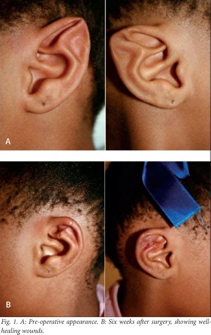 Mythological ears, a real deformity: A case of bilateral Stahl's ears in a South African girl