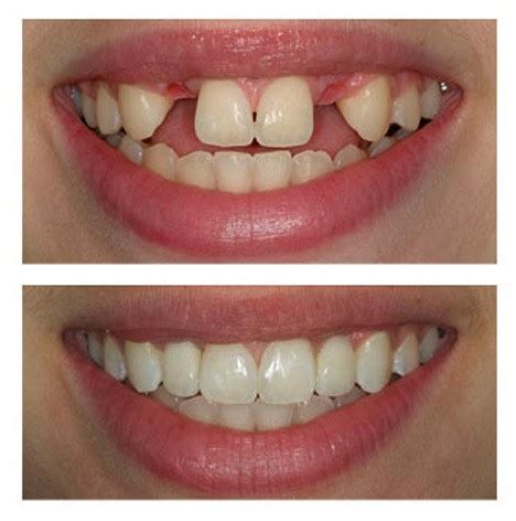 Dental Implant Before and After Photos