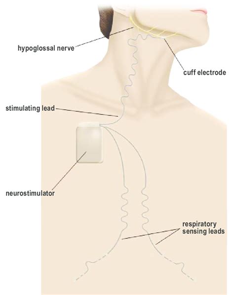 The implanted components of the hypoglossal nerve stimulating system... | Download Scientific ...