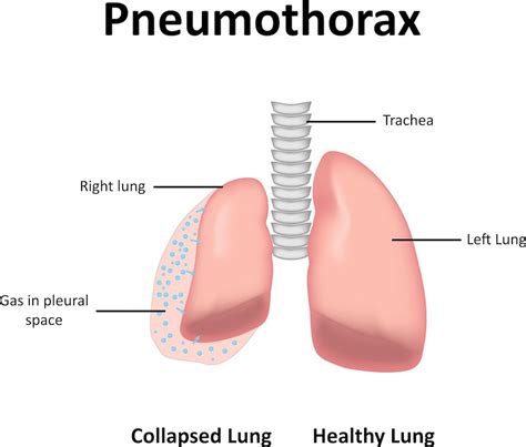 Diving Medicine - Pediatric Pulmonologists