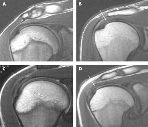 Reliability of MRI assessment of supraspinatus tendinopathy | British Journal of Sports Medicine