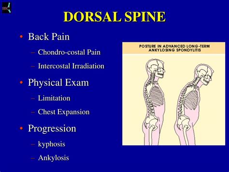 PPT - SERONEGATIVE SPONDYLARTHROPATHY PowerPoint Presentation, free ...