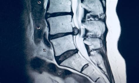 Failure to Diagnose Cauda Equina: $1 Million Lawsuit Settlement