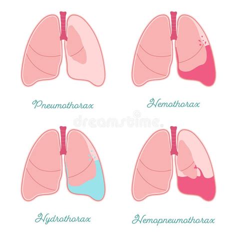 Pleural Effusions of Human Lung. Fluid or Air in Pleural Cavity ...