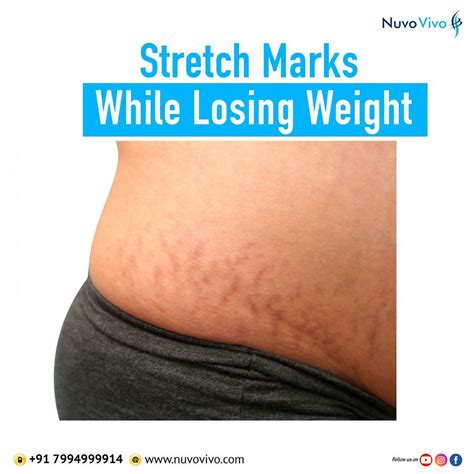 Stretch marks while losing weight? - NuvoVivo: Reverse Your Age & Lifestyle Diseases