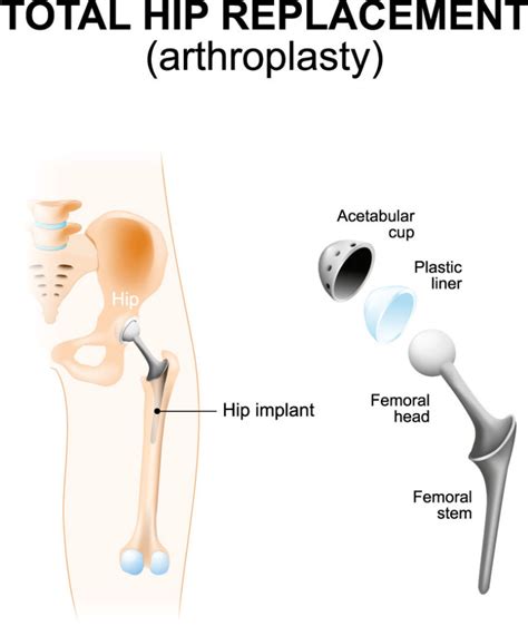 Hip Replacement Surgery (Total Hip Arthroplasty) - Schulze Orthopedics