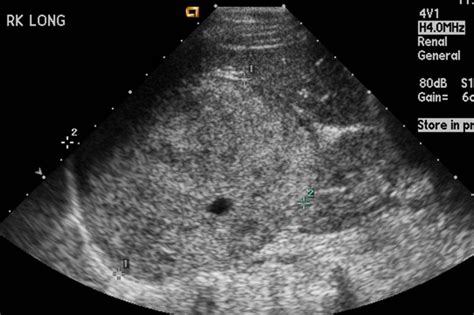 Pheochromocytoma echocardiography or ultrasound - wikidoc