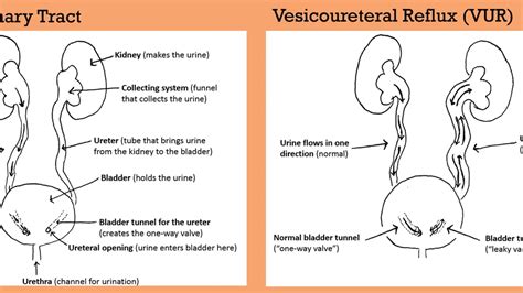 Understanding Vesicoureteral Reflux in Children: Risk Factors, Treatment, and Future Insights