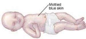 Mottled Skin - Pictures, What is, Causes, Treatment, Diagnosis