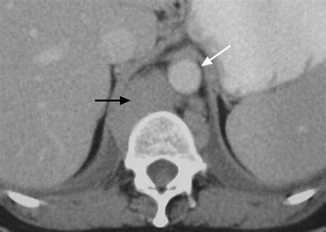 The Diaphragmatic Crura and Retrocrural Space: Normal Imaging Appearance, Variants, and ...