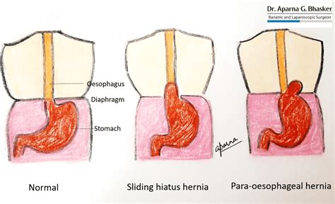 Stomach Hernia Surgery