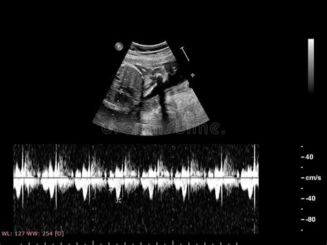 Ultrasound Screen With Fetal Echocardiography Stock Image - Image of heart, blood: 163296797