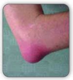 All About Bursitis