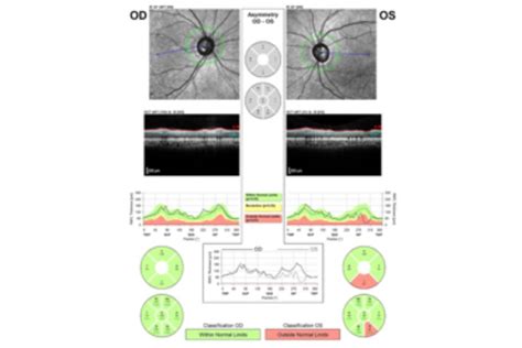 Retinal-Nerve-Fibre-Layer-(RNFL)-analysis - Edgbaston Eye Clinic