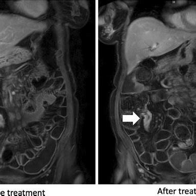 Colonoscopic image of patients with a ascending colon stricture with... | Download Scientific ...