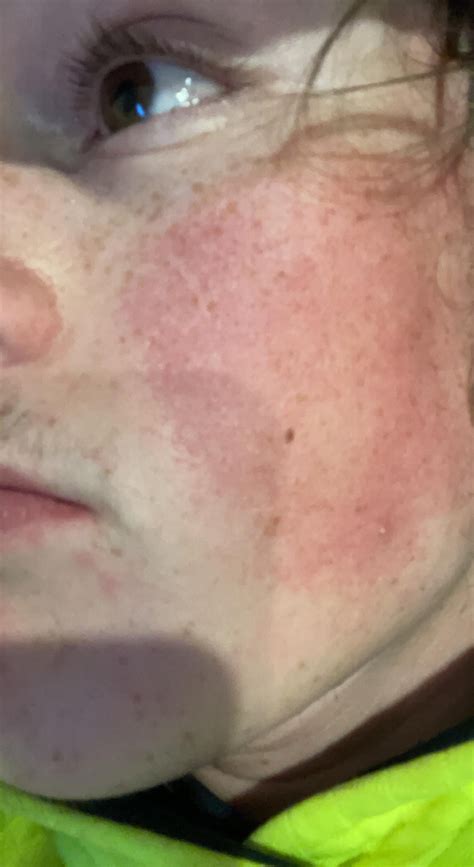 Metronidazole gel. Before/1 week after use/3 weeks after use.improvement : r/Rosacea