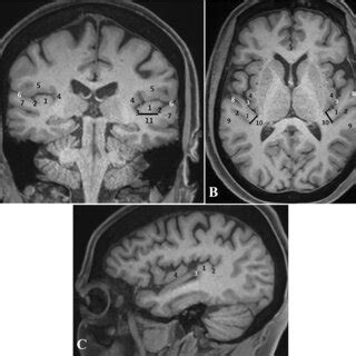 Arterial vasculature of the Heschl Gyrus. A, C, E: Axial, right... | Download Scientific Diagram