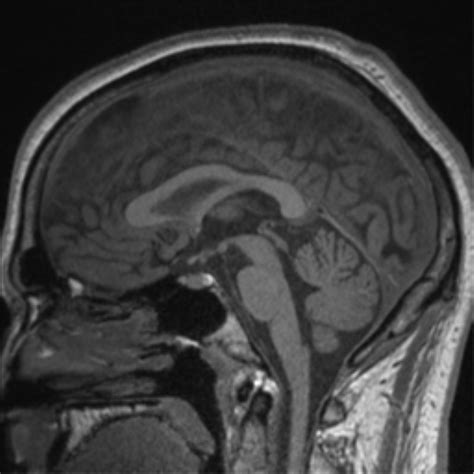 Pineal Gland Mri