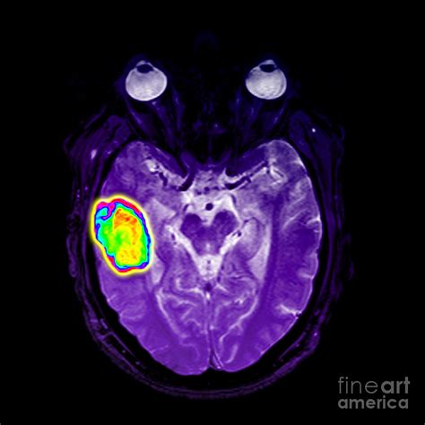 Mri Of Temporal Lobe Hematoma Photograph by Living Art Enterprises