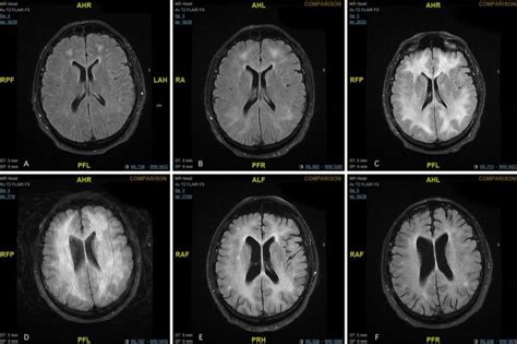 Doctors release scans of brain showing effects of cocaine use | Photo