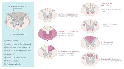 Poliomyelitis Spinal Cord