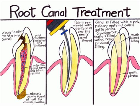 Maybe You Need a "Spiritual Root Canal" - www.jimduggan.org