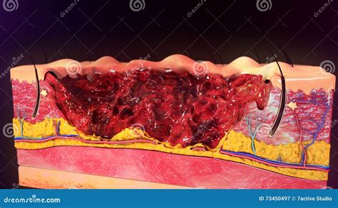 Third Degree Burn stock image. Image of second, entire - 73450497