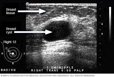 Ultrasound of breast cyst - Mayo Clinic