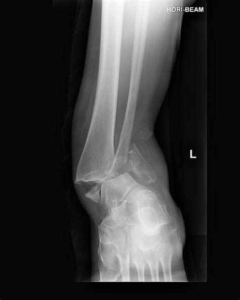 Fracture-dislocation of the ankle | Radiology Case | Radiopaedia.org | Radiology, Fracture ...