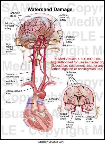 Watershed Damage Medical Illustration Medivisuals