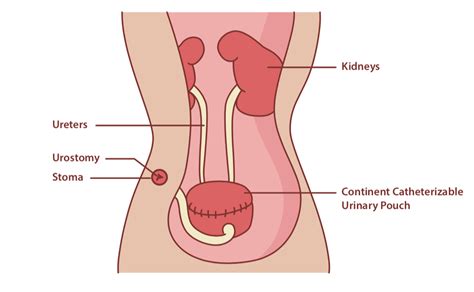 Urostomy Complications: What to Expect After Your Surgery - CompactCath