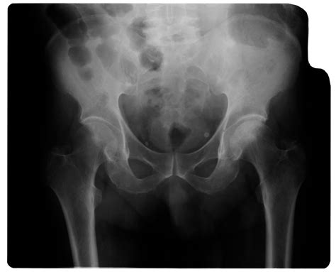 X-rays Alone Miss Many Cases of Hip Osteoarthritis : Sonos Imaging