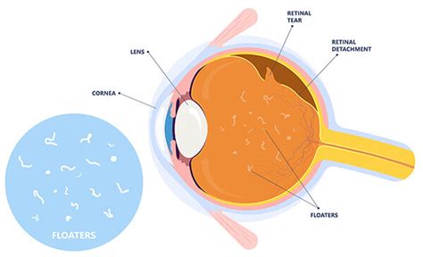 Eye Floaters Collingswood | Retinal Detachment Camden County