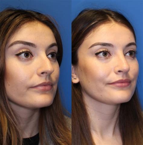 Nose Surgery Before & After Photos Patient 234 | San Francisco, CA | Kaiser Permanente Cosmetic ...