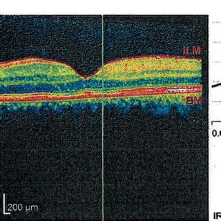 OCT of the macula of the left eye (April 2012) -patient' s own photo ...