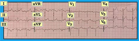 ECG Interpretation: ECG Blog #127 (Acute STEMI – Lead Malposition – LVH – Reciprocal Changes)