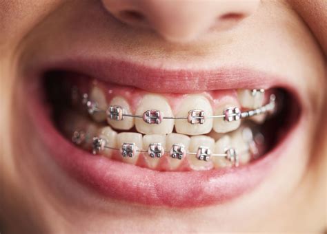 How can Teeth Alignment Improve Your Oral Health? - Esthetica