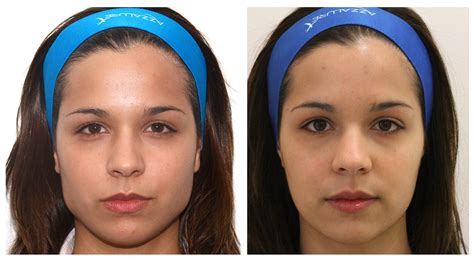 Non-Surgical Facial Slimming | Reshape Your Face | DrBK