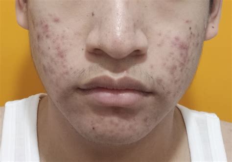 Excessive acne breakout from working - General acne discussion - Acne.org