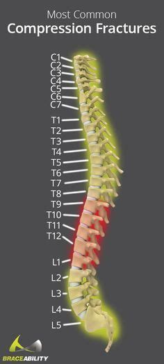 T12 Compression Fracture of Thoracic Spine | Thoracic, Anatomy, Spines