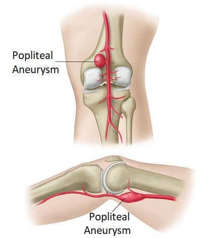 Pain And Swelling Behind Knee Online | cityofclovis.org