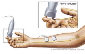 Nerve Conduction Study and EMG