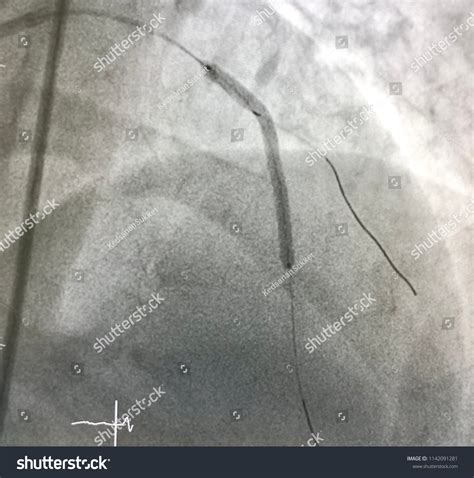 Coronary Stent Deployed Left Anterior Descending Stock Photo 1142091281 | Shutterstock